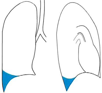 Гидроторакс Гидроторакс