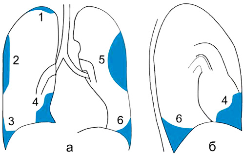 Фиброзные утолщения плевры Фиброзные утолщения плевры