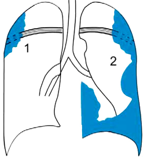 Злокачественная мезотелиома Злокачественная мезотелиома