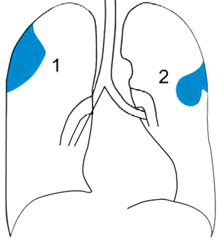 Доброкачественные опухоли плевры Доброкачественные опухоли плевры
