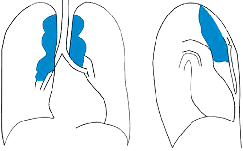 Лимфома Лимфома
