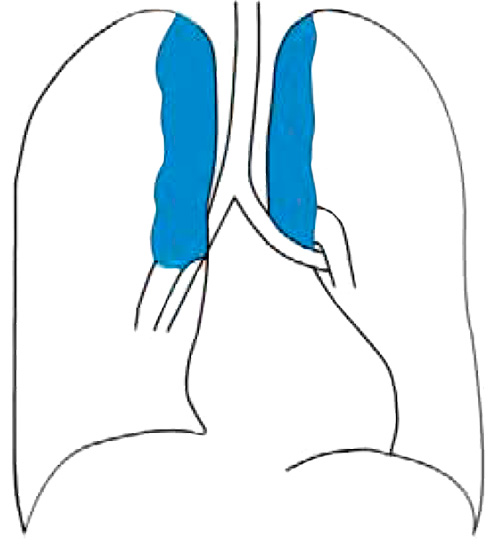 Симптом «печной трубы» Симптом «печной трубы»