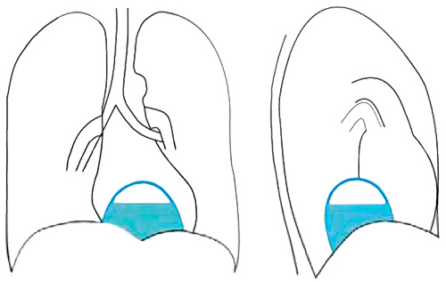 Грыжа пищеводного отверстия диафрагмы Грыжа пищеводного отверстия диафрагмы
