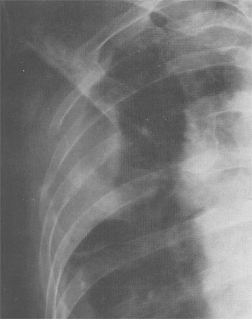 Злокачественная мезотелиома плевры Злокачественная мезотелиома плевры