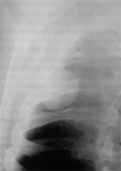 Фиброма плевры Фиброма плевры
