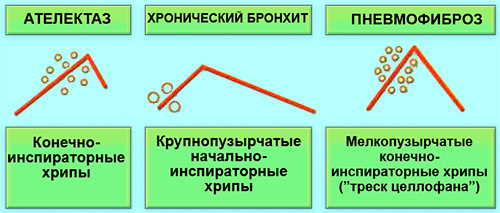 Аускультация Аускультация