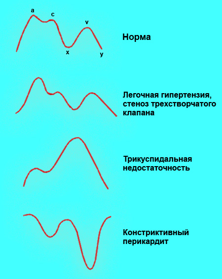 Венозный пульс Венозный пульс