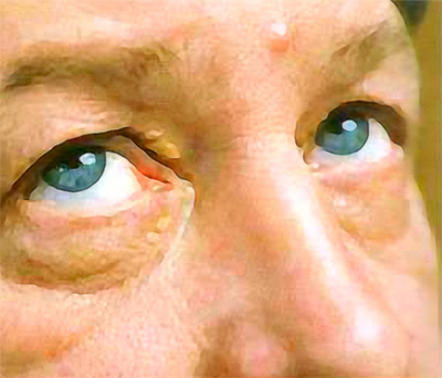 Ксантелазмы Ксантелазмы