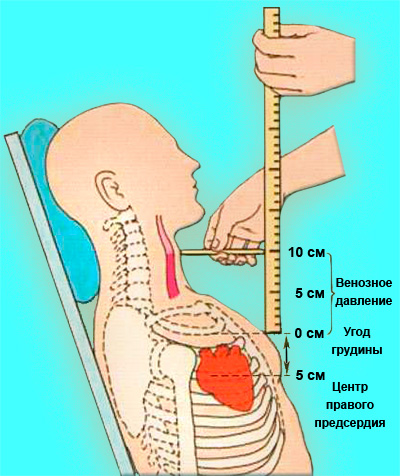 Измерение венозного давления в яремных венах Измерение венозного давления в яремных венах