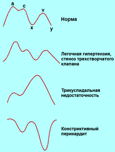 Патологическое изменения кривой венозного пульса Патологическое изменения кривой венозного пульса