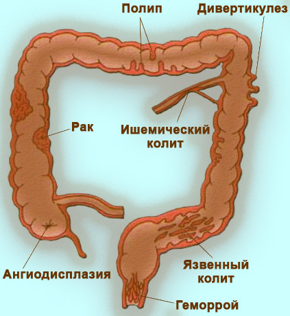 Кровь в кале Кровь в кале