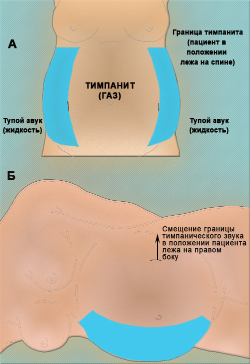 Симптом смещающейся тупости Симптом смещающейся тупости