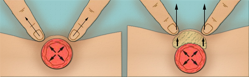 Пальпация брюшной аорты Пальпация брюшной аорты