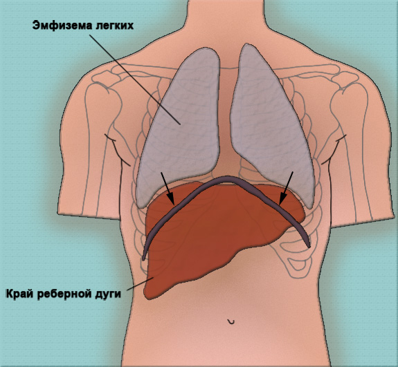 Опущение печени Опущение печени