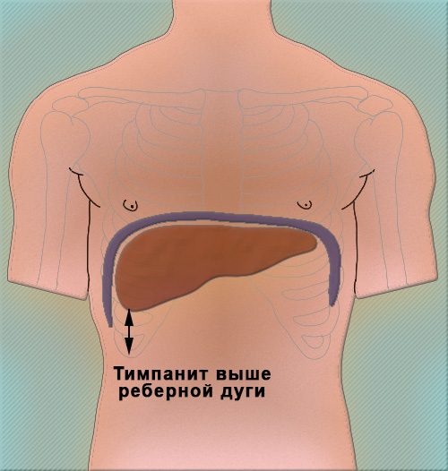 Сморщенная печень Сморщенная печень