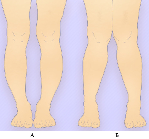 Деформация коленных суставов Деформация коленных суставов
