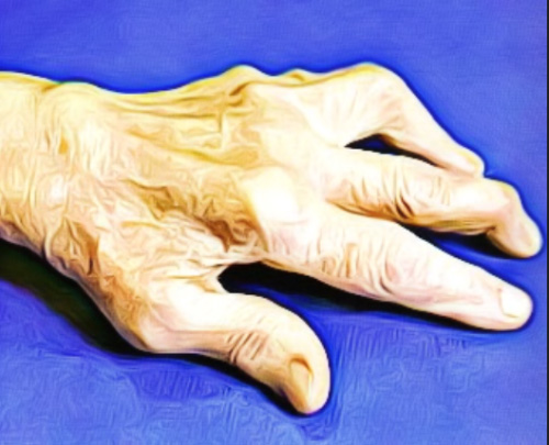 Деформация пальцев кисти Деформация пальцев кисти