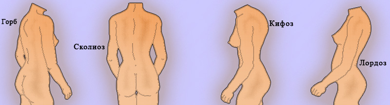 Деформация позвоночника Деформация позвоночника