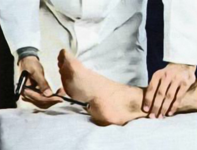 Исследование подошвенного рефлекса Исследование подошвенного рефлекса