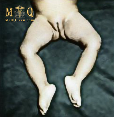 Паралич нижних конечностей с атрофией мышц Паралич нижних конечностей с атрофией мышц