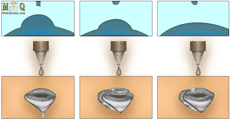 Распределение разных видов глазных капель на поверхности глаза Распределение разных видов глазных капель на поверхности глаза
