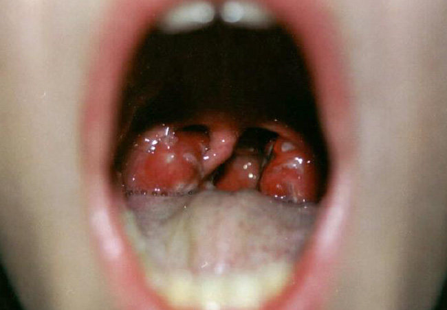 Скарлатина Скарлатина