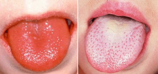 Скарлатина Скарлатина