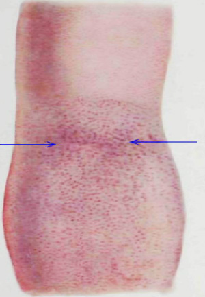 Симптом Пастиа Симптом Пастиа