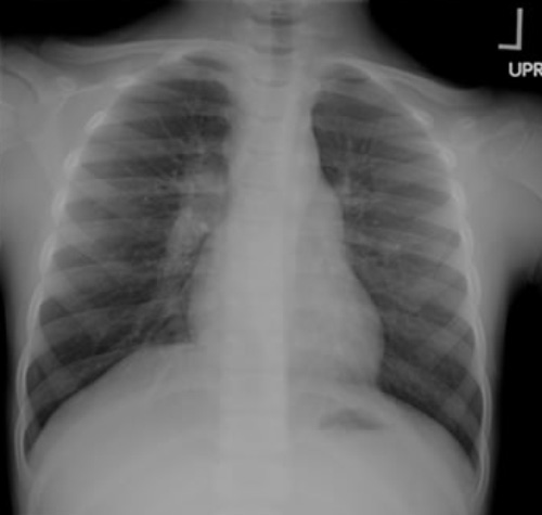 Туберкулез легких Туберкулез легких