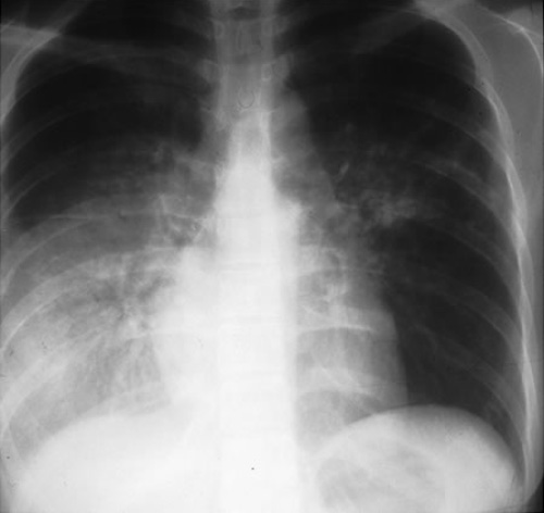 Туберкулез легких Туберкулез легких