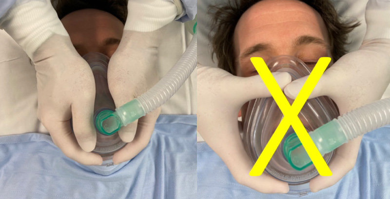 Вентиляция легких у больного, инфицированного COVID-19 Вентиляция легких у больного, инфицированного COVID-19