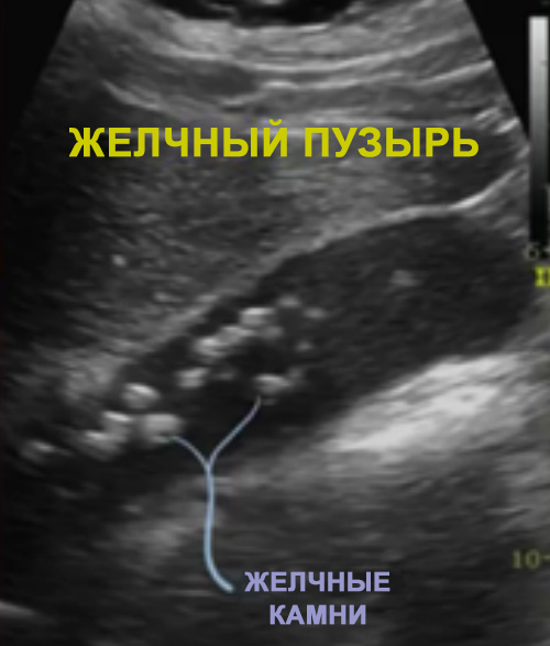 УЗИ желчного пузыря УЗИ желчного пузыря