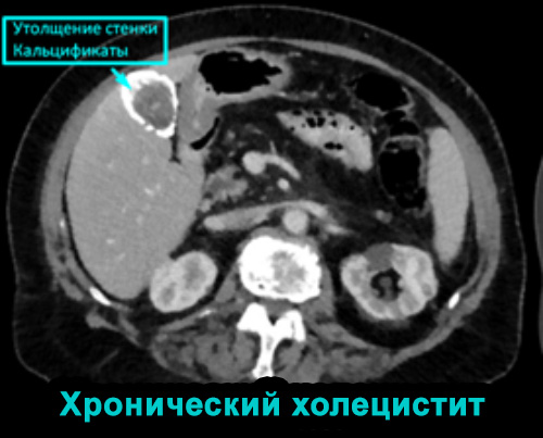 ХРОНИЧЕСКИЙ ХОЛЕЦИСТИТ ХРОНИЧЕСКИЙ ХОЛЕЦИСТИТ