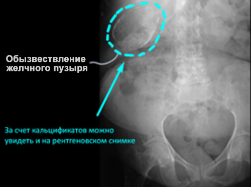 ХРОНИЧЕСКИЙ ХОЛЕЦИСТИТ ХРОНИЧЕСКИЙ ХОЛЕЦИСТИТ