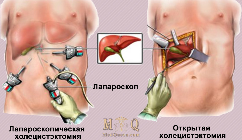 Холецистэктомия Холецистэктомия