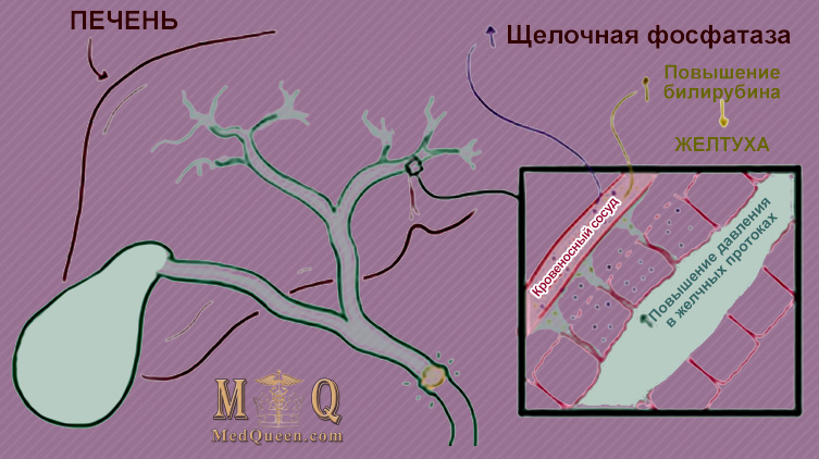 Патогенез холецистита Патогенез холецистита