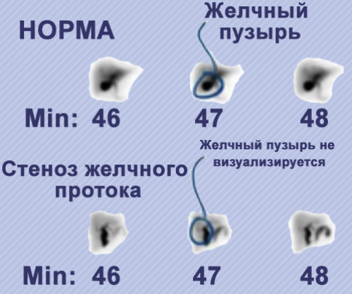 Холецистография Холецистография