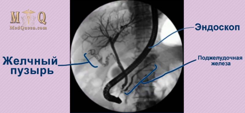 Ретроградная холангиопанкреатография (ERCP – Endoscopic retrograde cholangiopancreatography) Ретроградная холангиопанкреатография (ERCP – Endoscopic retrograde cholangiopancreatography)