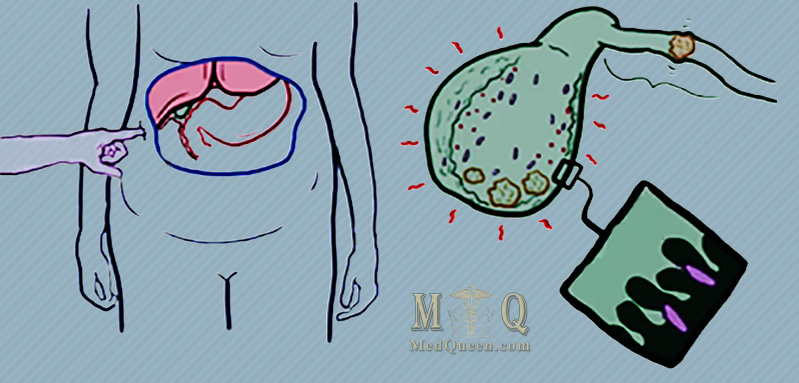 Патогенез холецистита Патогенез холецистита