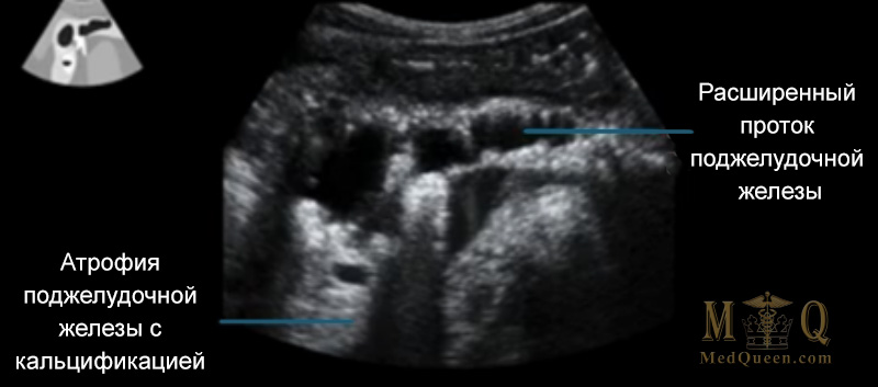 Хронический панкреатит Хронический панкреатит