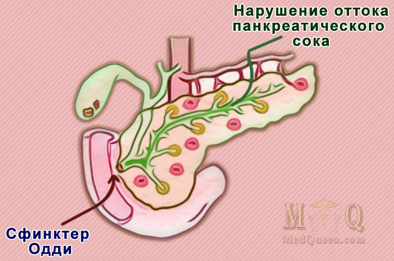 Камни в желчном пузыре Камни в желчном пузыре