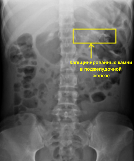 Кальцинированные камни в поджелудочной железе Кальцинированные камни в поджелудочной железе