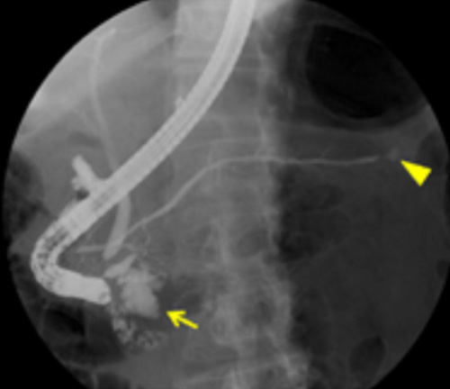 Ретроградная холангиопанкреатография Ретроградная холангиопанкреатография