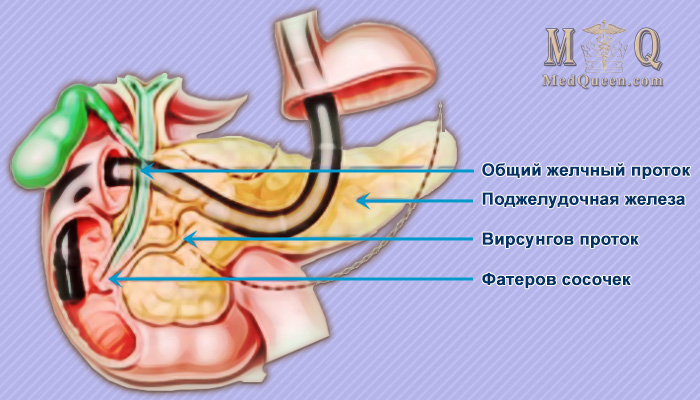 Ретроградная холангиопанкреатография Ретроградная холангиопанкреатография