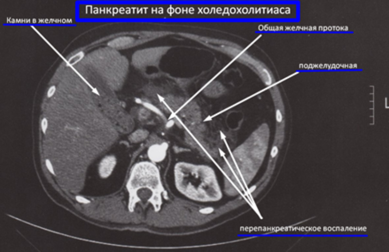 Панкреатит на фоне холедохолитиаза Панкреатит на фоне холедохолитиаза