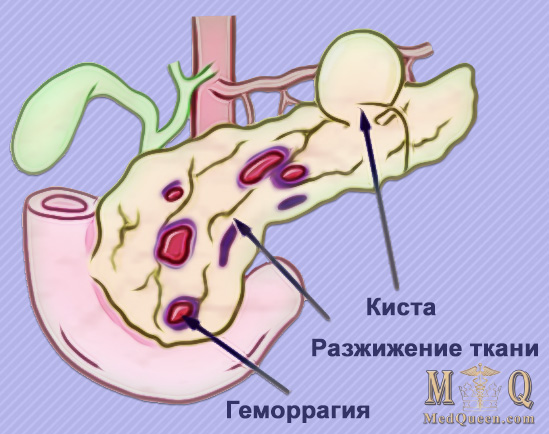 Панкреатит Панкреатит