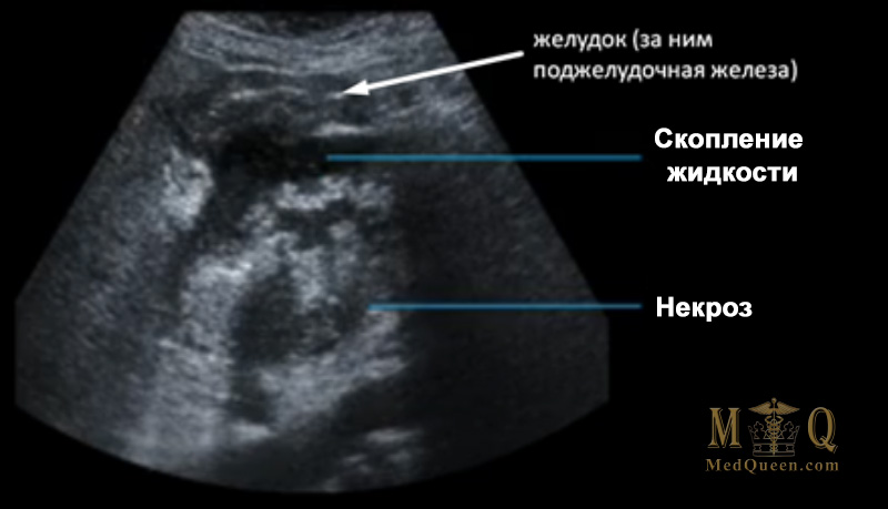 Некротический панкреатит Некротический панкреатит