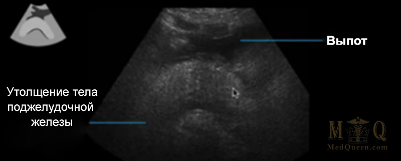 Интерстициальный отечный панкреатит Интерстициальный отечный панкреатит