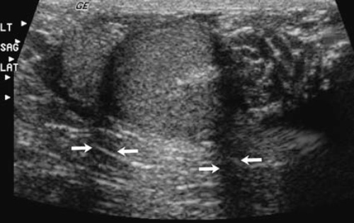 УЗИ: Артефакт преломления УЗИ: Артефакт преломления
