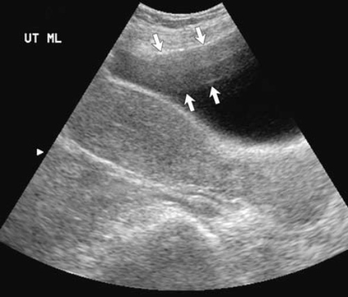 УЗИ: Артефакт реверберации УЗИ: Артефакт реверберации